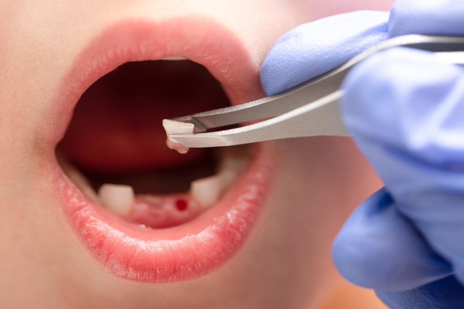 Removal of a Milk Tooth. the Doctor Pulled Out a Tooth from a Child with Tweezers. Extraction of a Child's Tooth with a Dental Instrument.
