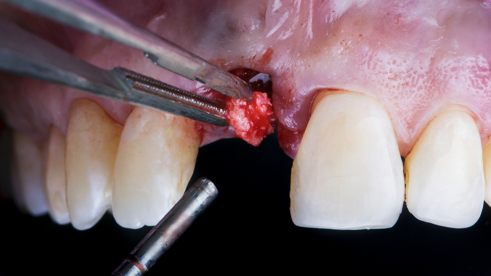 Bone Embedding Fragment during Implantation