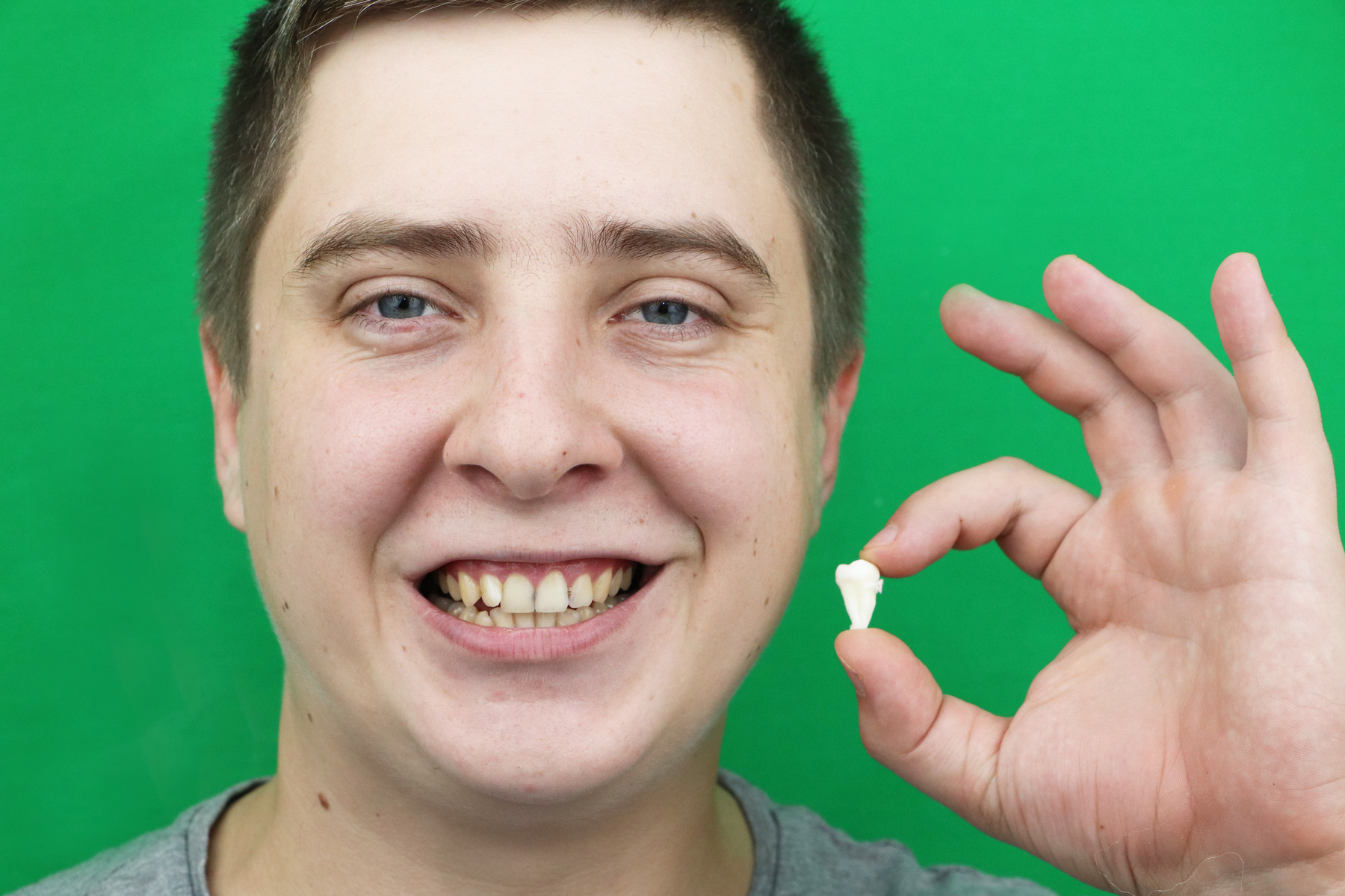 A man after removing a wisdom tooth. The operation to remove the eighth teeth